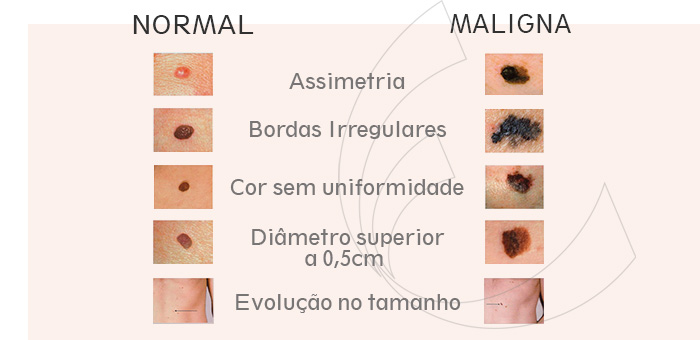 REGRA ABCDE PARA AUXILIAR NO DIAGNÓSTICO DE MELANOMA