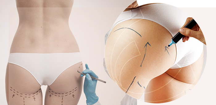 Gluteoplastia